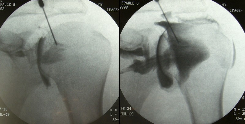 Arthrographie epauleGauche